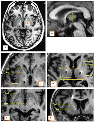 Prediction of Clinical Deep Brain Stimulation Target for Essential Tremor From 1.5 Tesla MRI Anatomical Landmarks